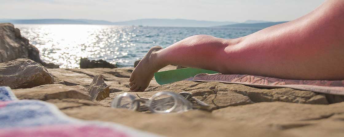 oparzenia słoneczne plaża słońce