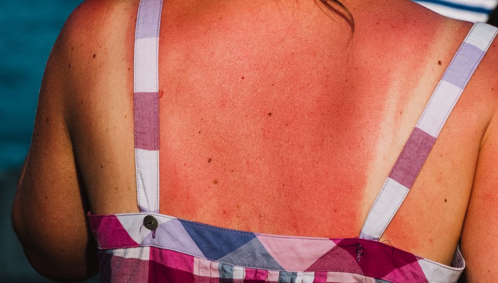 Close up on burnet skin by the sun on the woman 